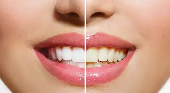 Teeth Whitening Singapore