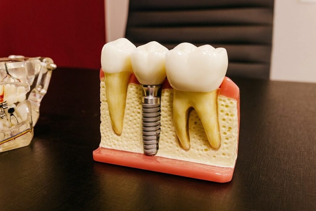 Dental Tooth Implant
