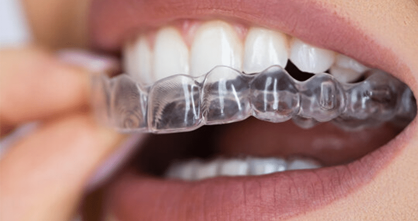 SG Dental aligners