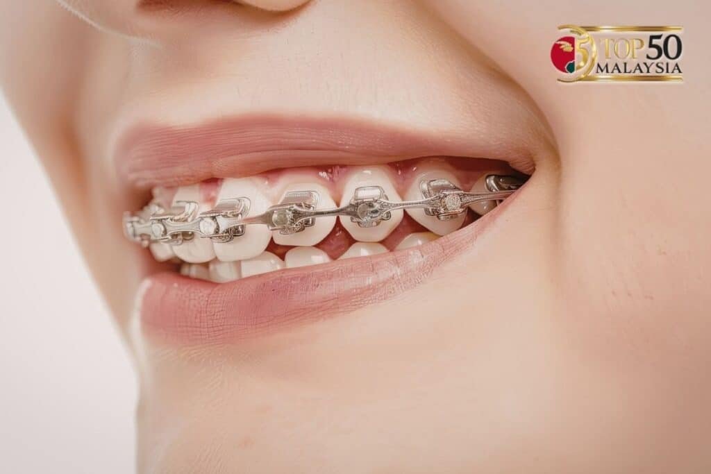 Why Singaporeans Pick SG Dental Aligners Over Traditional Braces?