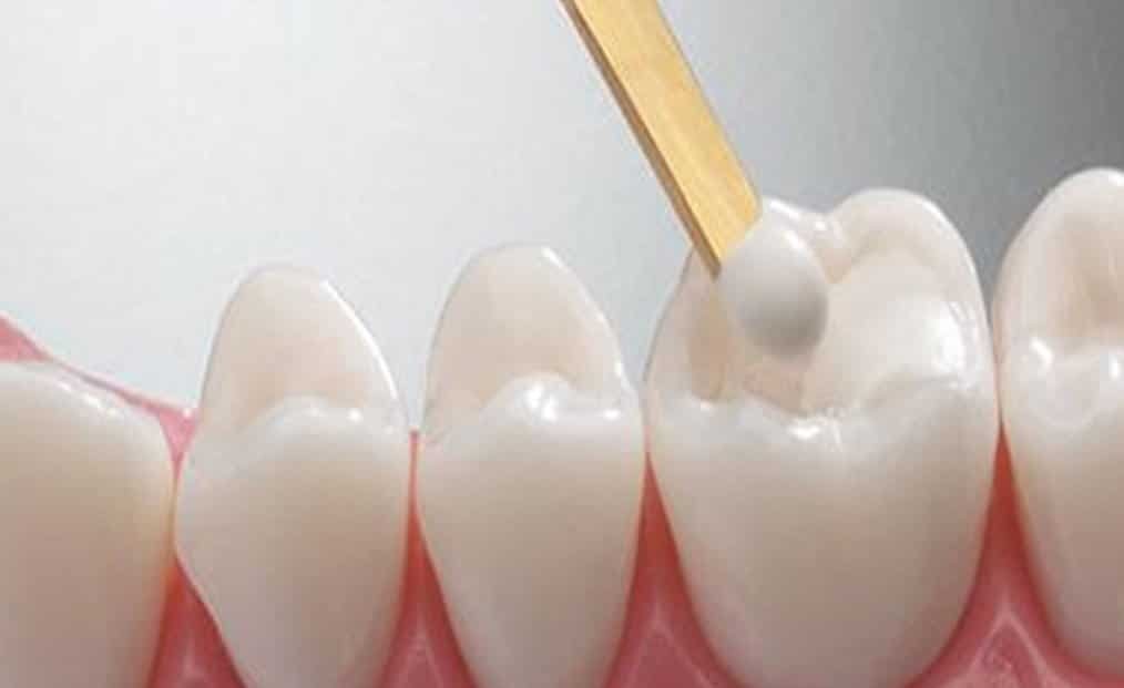 Dental Filling SG Recommended